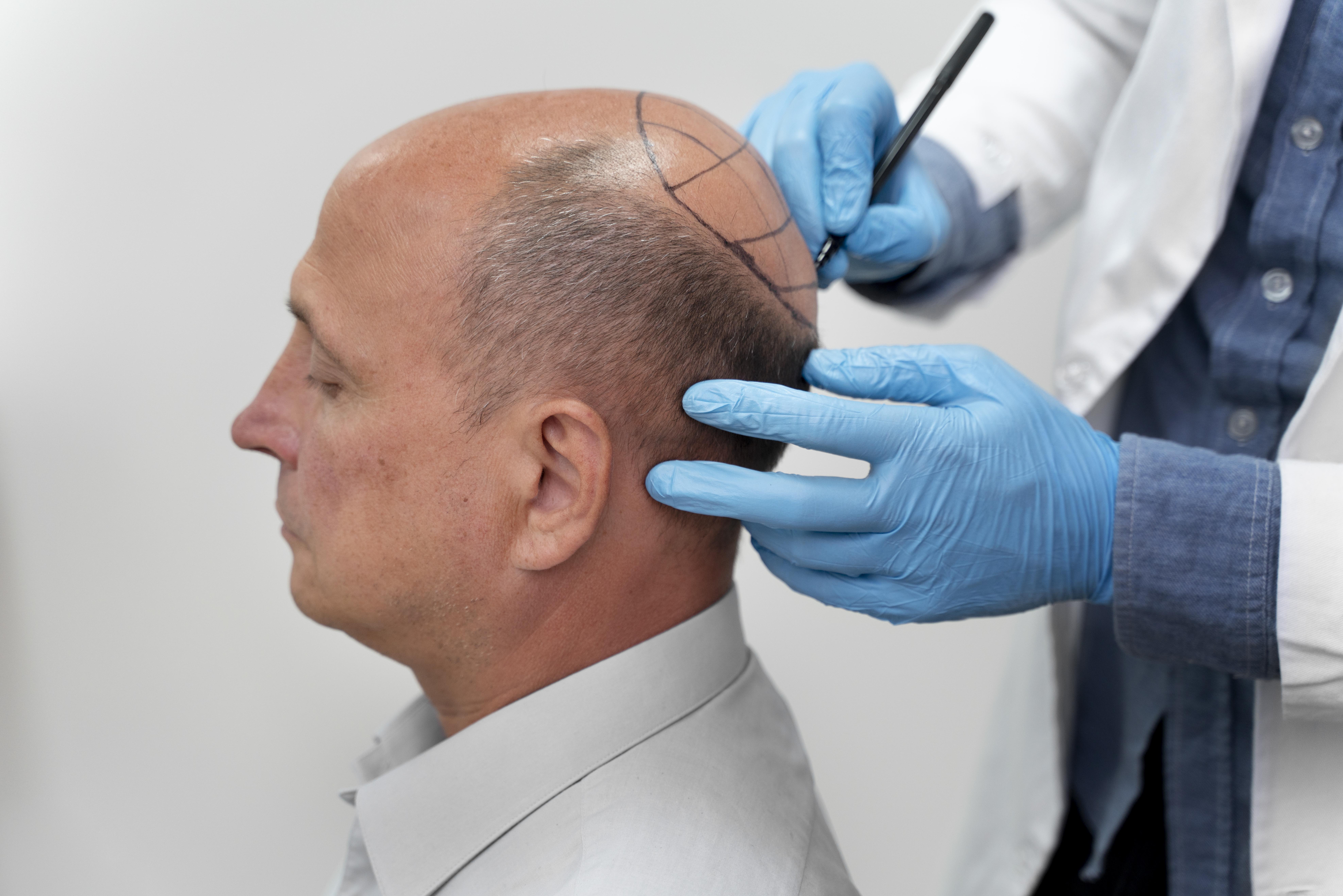 6 Important Things You Should Know Before a Hair Transplant
